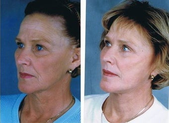 Facelift, Neck lift, Superficial cheek lift, CO2 laser resurfacing before 83153