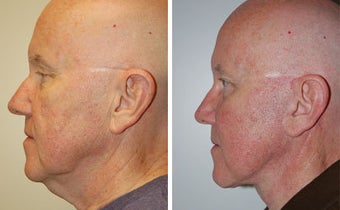 Facelift before 91470