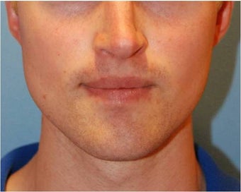Jaw Implants for Jaw Augmentation after 130941