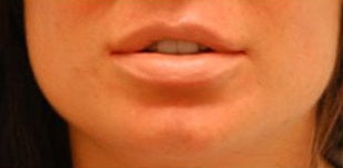 Corrective Lip Reduction after 136735