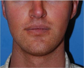 Jaw Implants for Jaw Augmentation before 130941