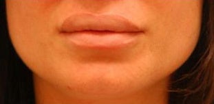 Corrective Lip Reduction before 136735