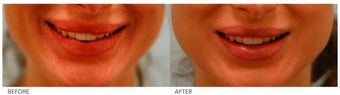 Lip Reduction/Lip Correction before 136739