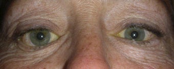 Orbital Decompression with Fat and Bone Removal after 246134