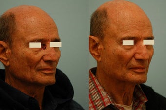 Facial Reconstruction before 136834