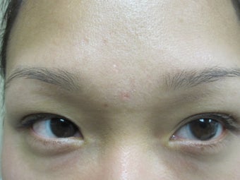 Sebaceous Hyperplasia Before & After Treatments photo from H.L