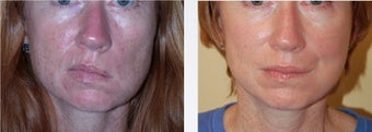 Facial Paralysis and Reconstruction before 346223
