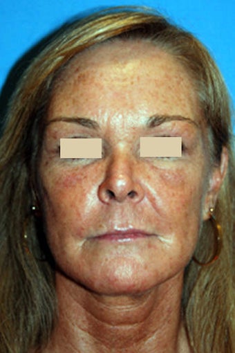 Fat Transfer / Fat Grafting / YoungVolumizer Procedure after 166185