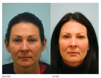 Fat Transfer and Facial Rejuvenation before 136356