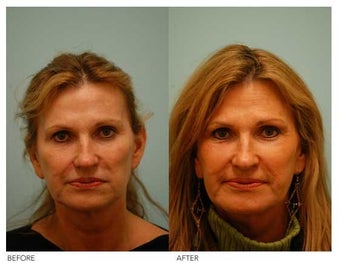 Fat Transfer/Fat Grafting/Facial Rejuvenation before 136361