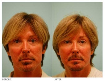 Fat Transfer/Fat Grafting/Facial Rejuvenation before 136365