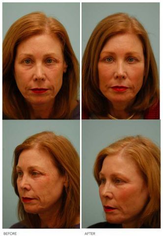 Fat Transfer/Fat Grafting/Facial Rejuvenation before 136366