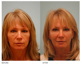 Fat Transfer/Fat Grafting/Facial Rejuvenation before 136374
