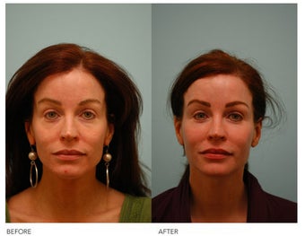 Fat Transfer/Fat Grafting/Facial Rejuvenation before 136381
