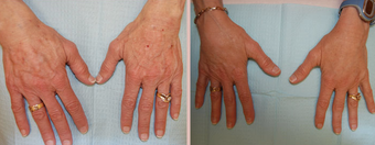 Hands - Fat Transfer before 293455