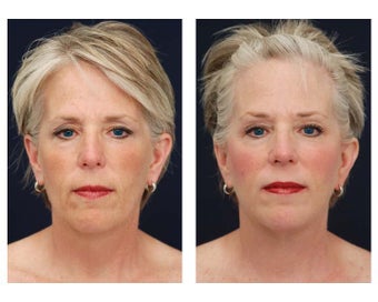 Neck Lift, Fat Grafting after 347553