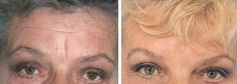 Forehead Lift before 652132