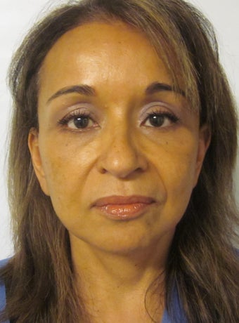 Forehead Lift after 562512