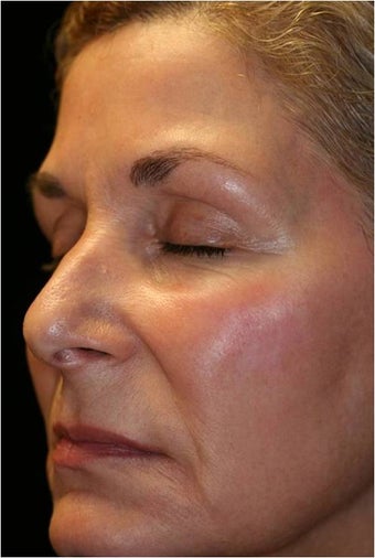 Fraxel - Melasma after 652383