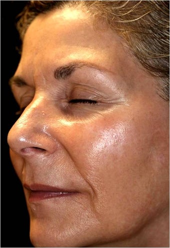 Fraxel - Melasma before 652383