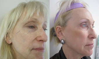 Fractional CO2 Laser Resurfacing after 387843