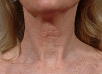 Laser resurfacing-Fraxel Re:store