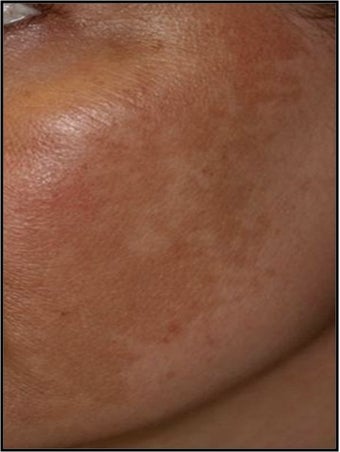 Fraxel - Melasma before 652319