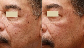 Fraxel Repair 2mm Spot before 138480
