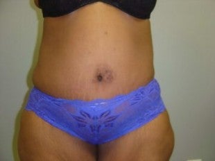 40 year old lady with excess skin after gastric bypass after 621310