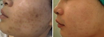 Green peel to hyper-pigmentation of cheek before 9841