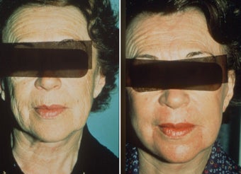 Green peel to face before 9844