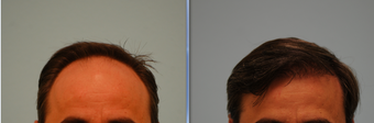 Hair Transplant before 315419