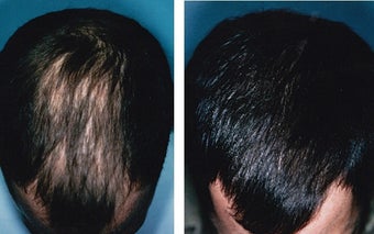 Medical treatment for hair loss (no surgery) before 369176