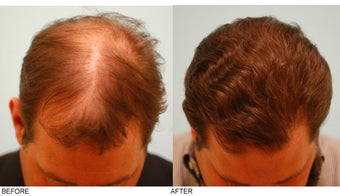 Hair Transplant after 137287