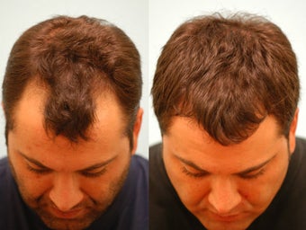 Hair Transplant before 133420