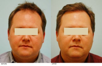 Hair Transplant before 134763