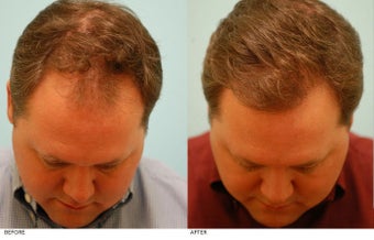Hair Transplant before 134766
