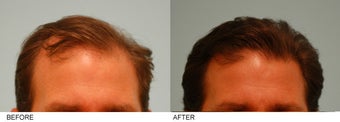 Hair Transplant before 137287