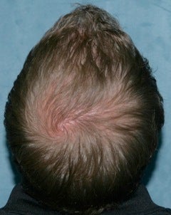 Hair transplant after 374216