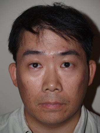 Hair Transplant after 392977