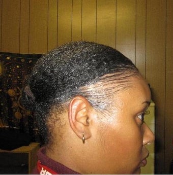 Hair Transplant 1400 Grafts before 332716
