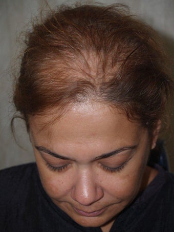 Hair Transplant before 357261