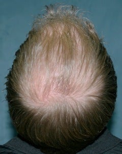 Hair transplant before 374216