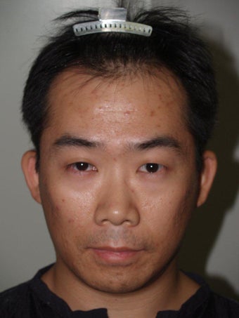 Hair Transplant before 392977