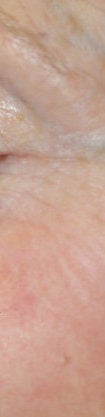 Spider hemangioma (blood freckle) laser treatments after 106562