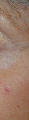 Spider hemangioma (blood freckle) laser treatments before 106562