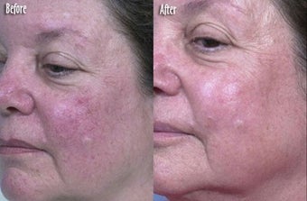 IPL for Spider Veins and Uneven Skin Texture before 6387