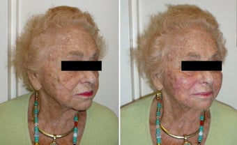 Facial Filler