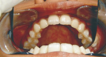 The Hollywood smile with Invisalign after 293409