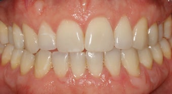 Narrow Arches, Gum Loss, Crowding after 296534